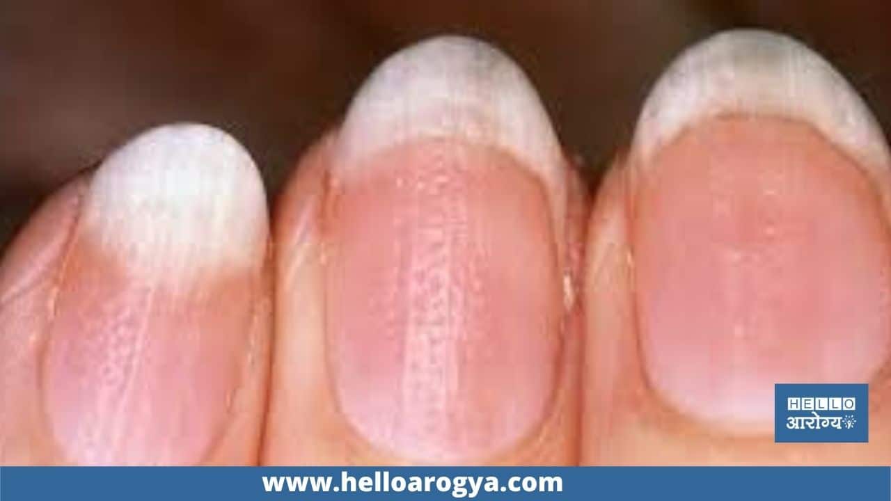 White nails determine your health