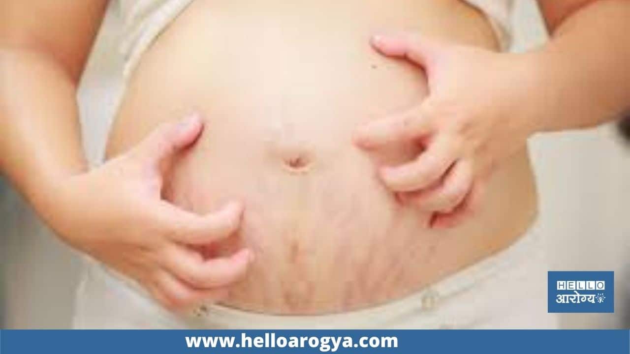 Why does itching occur during pregnancy?