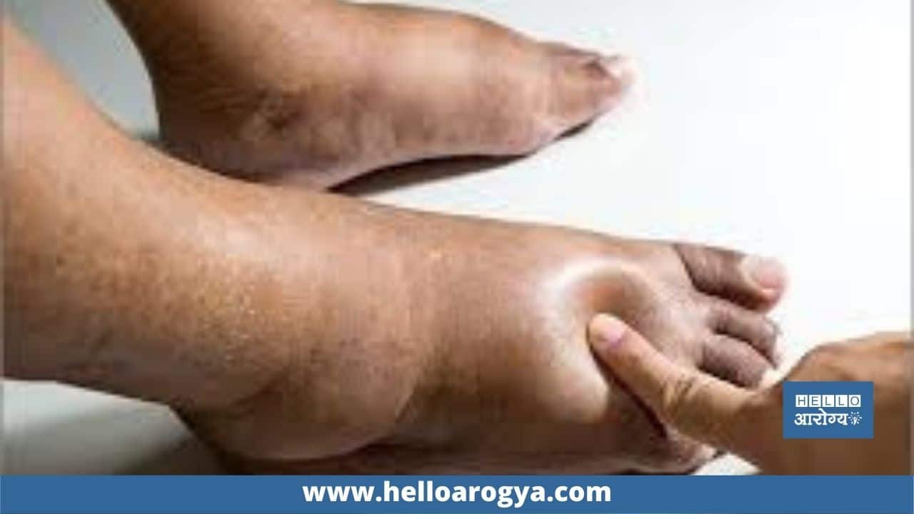 Diabetes and swelling of the feet