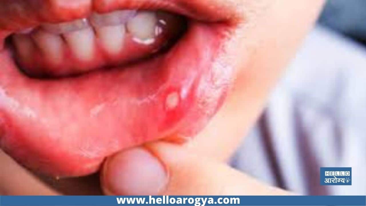 what is exactly mouth ulcer ?