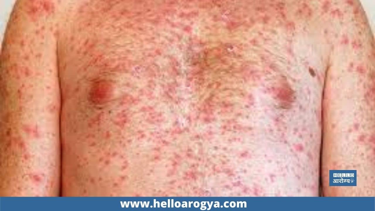 What are the causes of skin infections?
