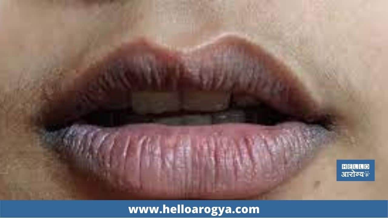 What to do when your lips turn black?