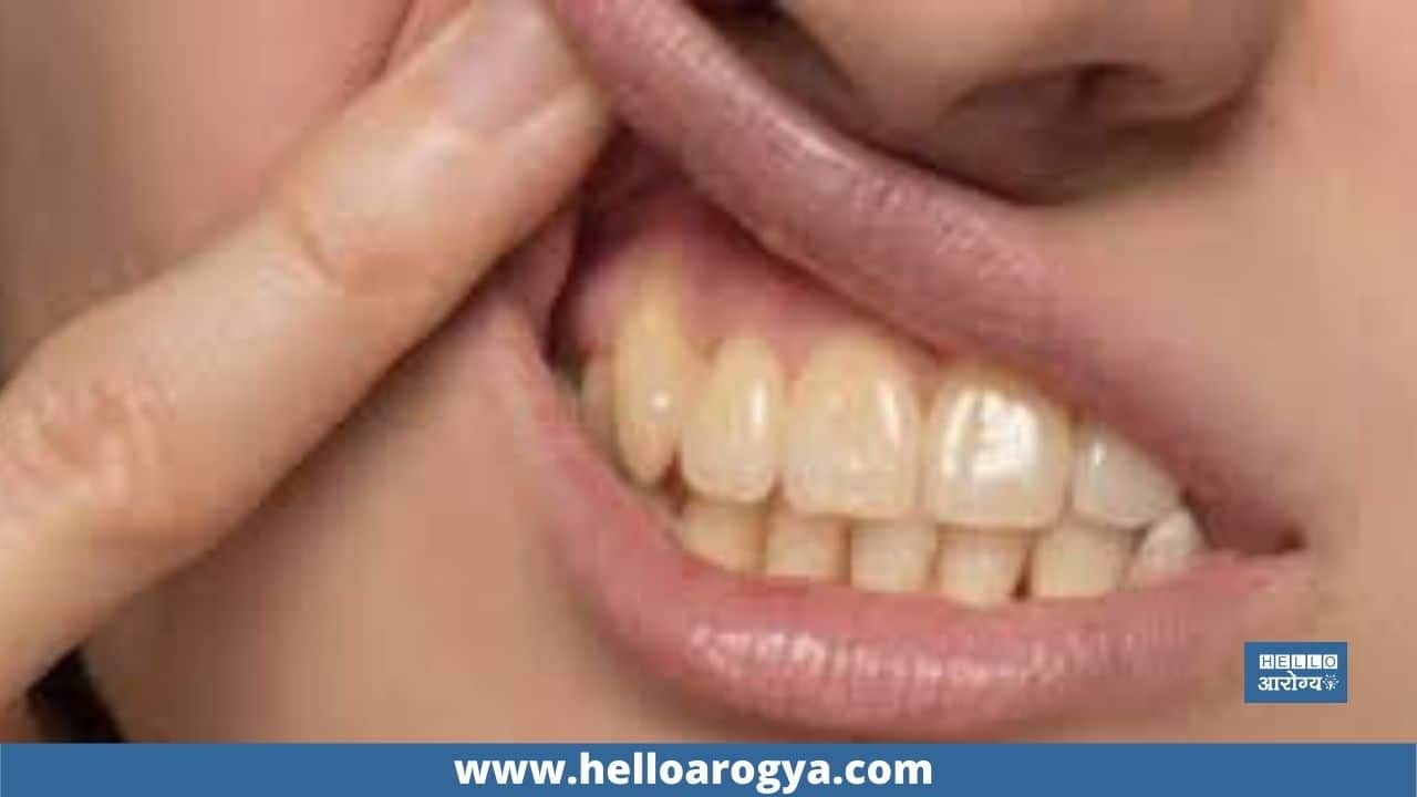 What are the remedies to eliminate yellowing of teeth