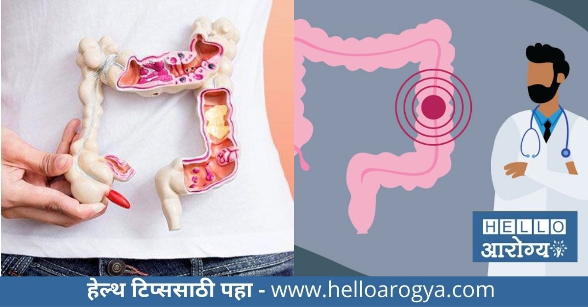 colon cancer treatment marathi information