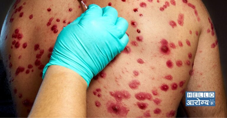 Herpes Disease : नागीण आजार संसर्ग जन्य आहे का? समज व गैरसमज जाणून घ्या