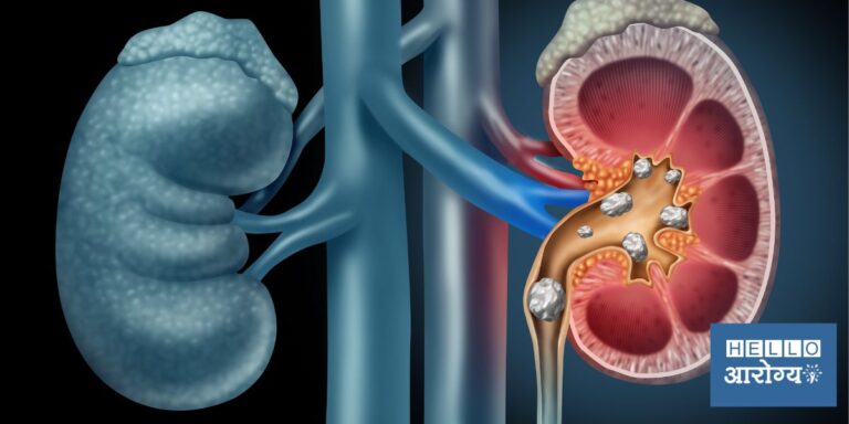 Kidney Stone | जास्त मीठ खाल्ल्याने होऊ शकतो किडनी स्टोन? जाणून घ्या सत्य